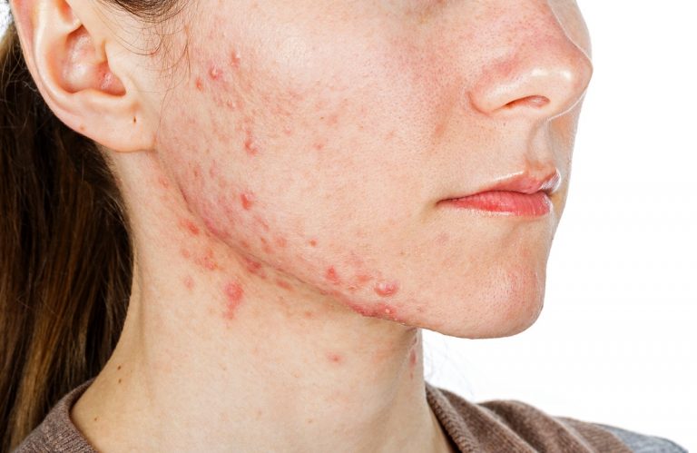 Woman with acne on her jaw